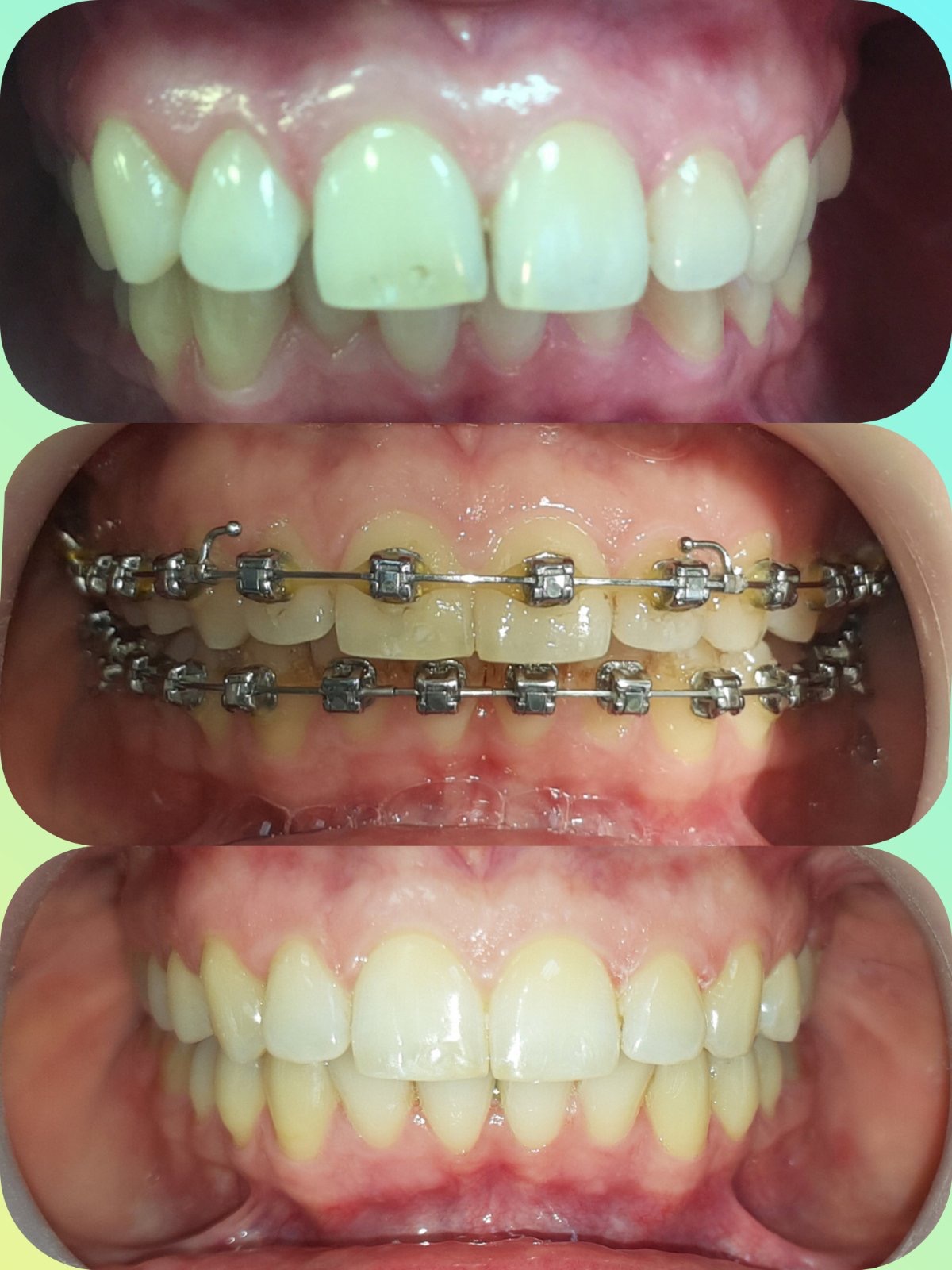 Aparaty na&nbsp;zęby Częstochowa - efekty leczenia