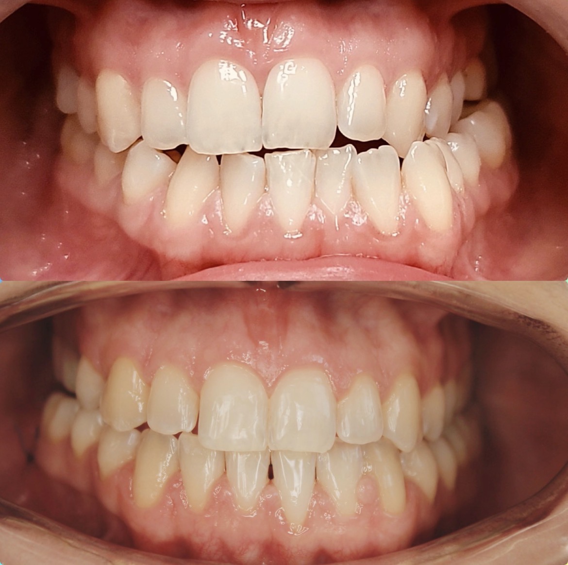 Efekty leczenia ortodontycnzego - przed&nbsp;po&nbsp;Częstochowa