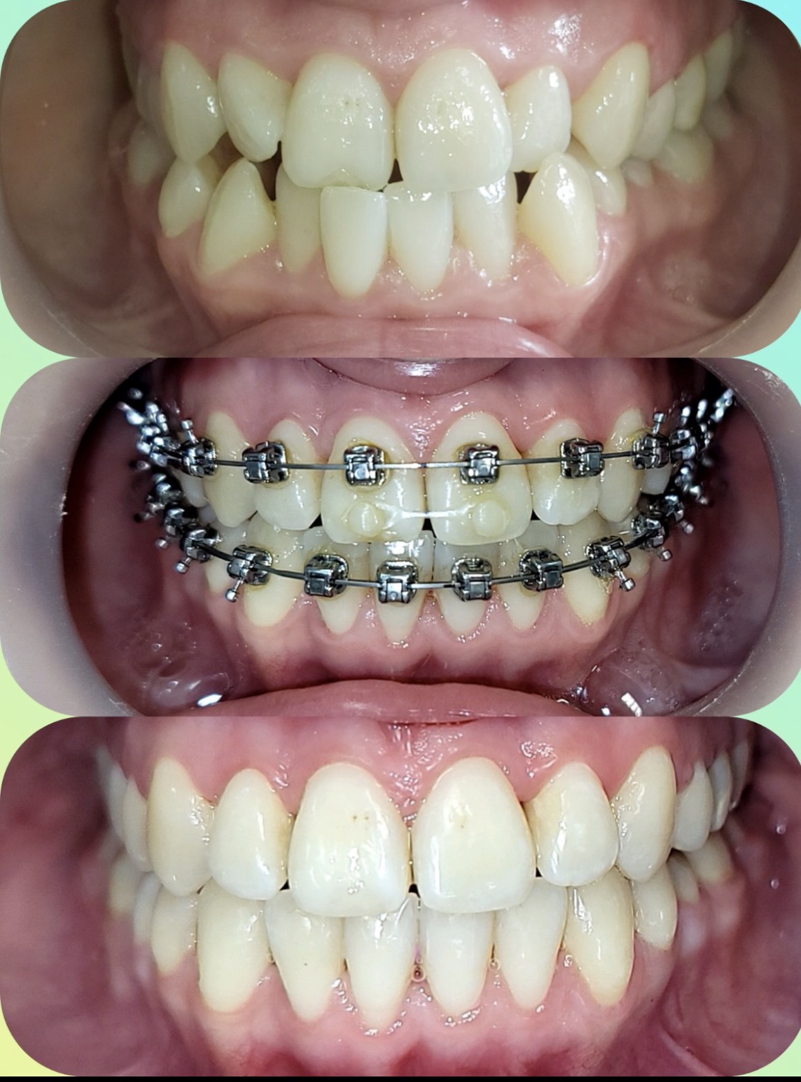 Leczenie ortodontyczne efekty