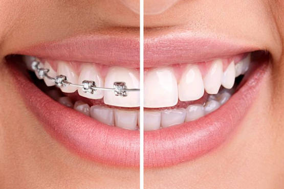 Ortodoncja Aparaty na&nbsp;zęby Częstochowa