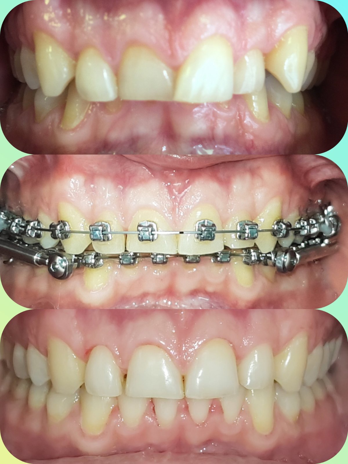 Ortodoncja Częstochowa - efekty